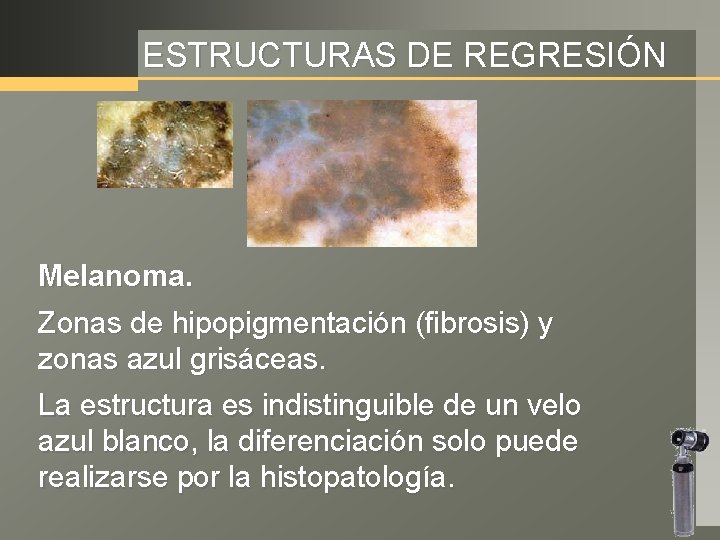 ESTRUCTURAS DE REGRESIÓN Melanoma. Zonas de hipopigmentación (fibrosis) y zonas azul grisáceas. La estructura