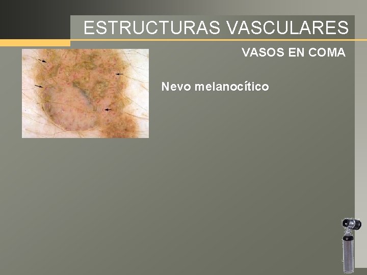 ESTRUCTURAS VASCULARES VASOS EN COMA Nevo melanocítico 