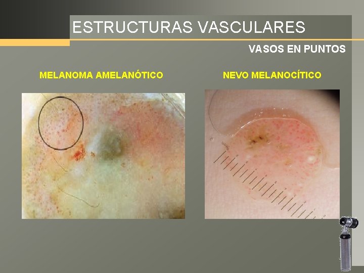 ESTRUCTURAS VASCULARES VASOS EN PUNTOS MELANOMA AMELANÓTICO NEVO MELANOCÍTICO 