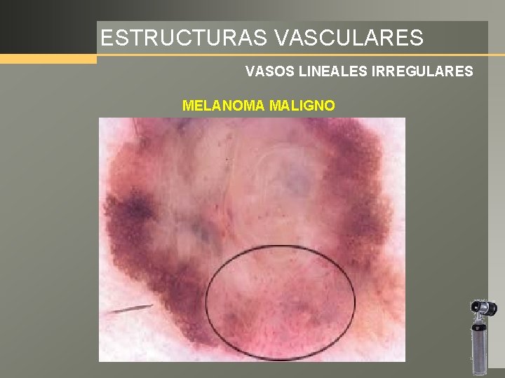 ESTRUCTURAS VASCULARES VASOS LINEALES IRREGULARES MELANOMA MALIGNO 