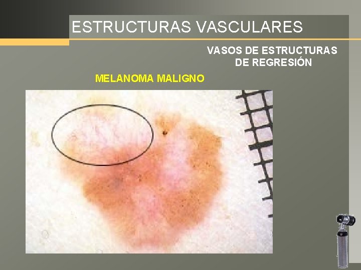 ESTRUCTURAS VASCULARES VASOS DE ESTRUCTURAS DE REGRESIÓN MELANOMA MALIGNO 