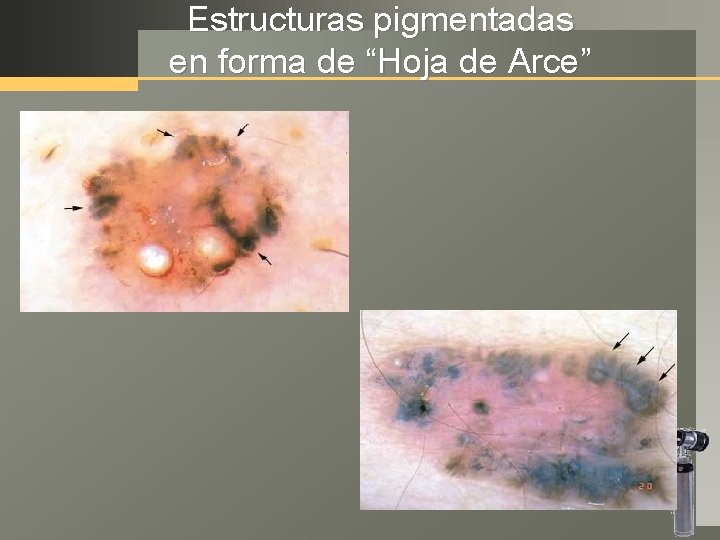 Estructuras pigmentadas en forma de “Hoja de Arce” 