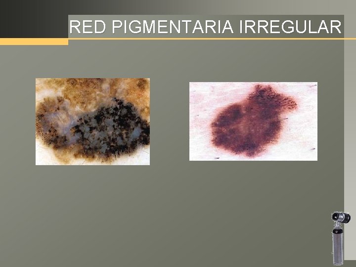 RED PIGMENTARIA IRREGULAR 