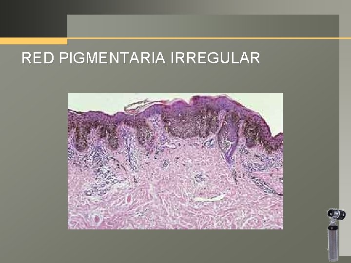 RED PIGMENTARIA IRREGULAR 