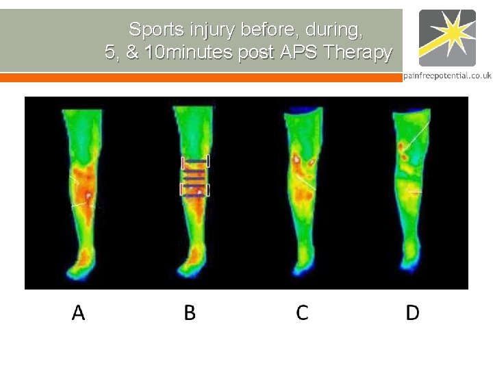 Sports injury before, during, 5, & 10 minutes post APS Therapy Sports injury before, during, 5, & 10 minutes post APS Therapy