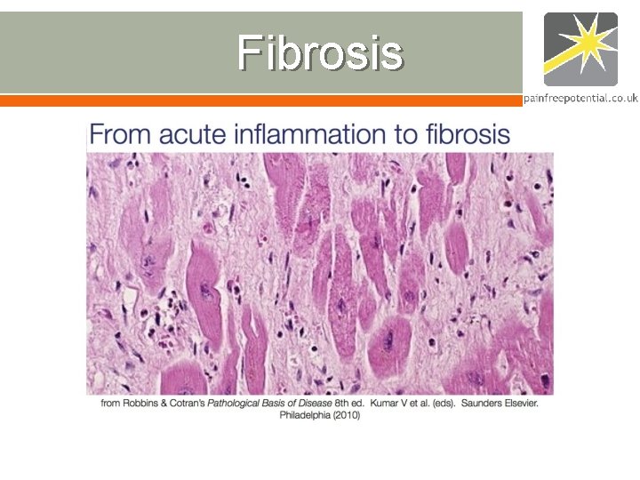 Fibrosis Fibrosis