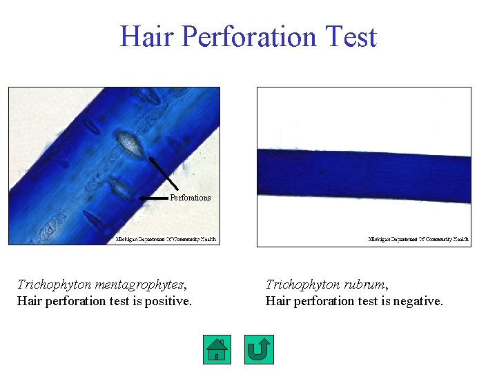 Hair Perforation Test Perforations Trichophyton mentagrophytes, Hair perforation test is positive. Trichophyton rubrum, Hair