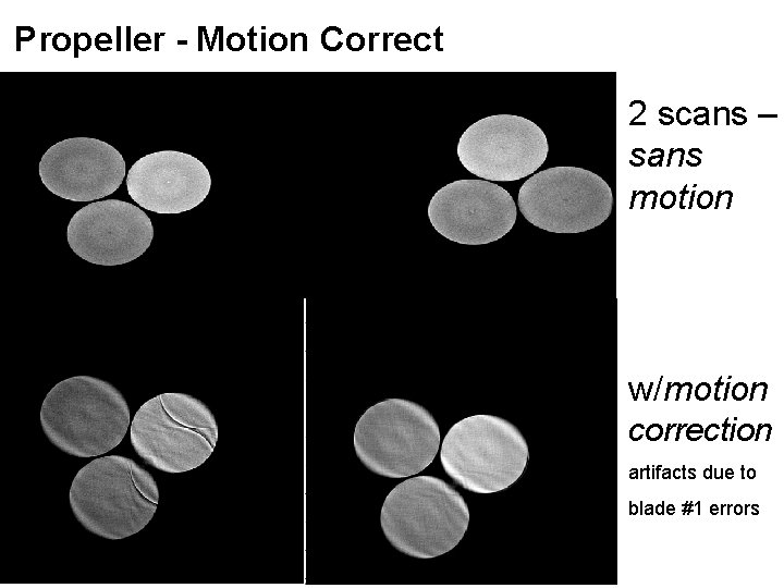 Propeller - Motion Correct 2 scans – sans motion correction w/motion correction artifacts due