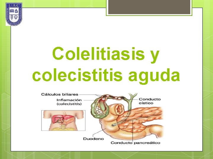 Colelitiasis y colecistitis aguda 