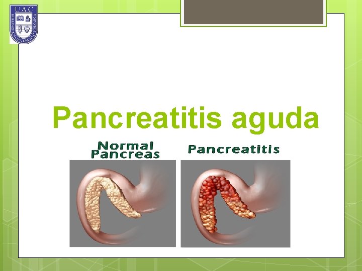 Pancreatitis aguda 