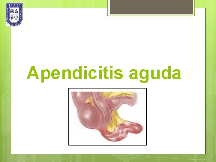 Apendicitis aguda 