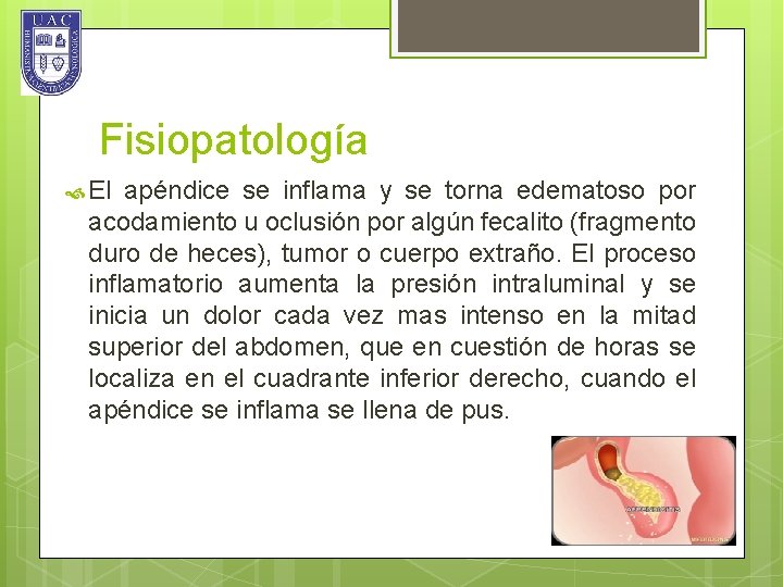 Fisiopatología El apéndice se inflama y se torna edematoso por acodamiento u oclusión por