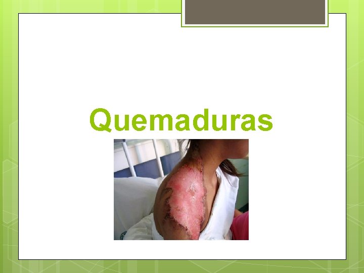 Quemaduras 