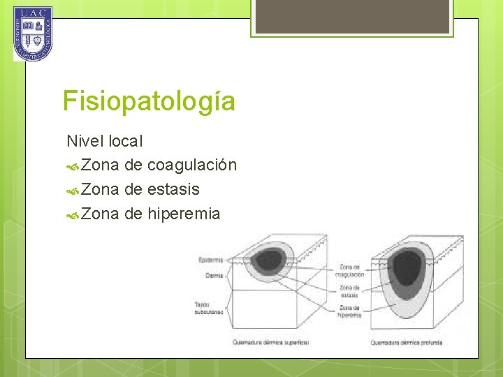 Fisiopatología Nivel local Zona de coagulación Zona de estasis Zona de hiperemia 