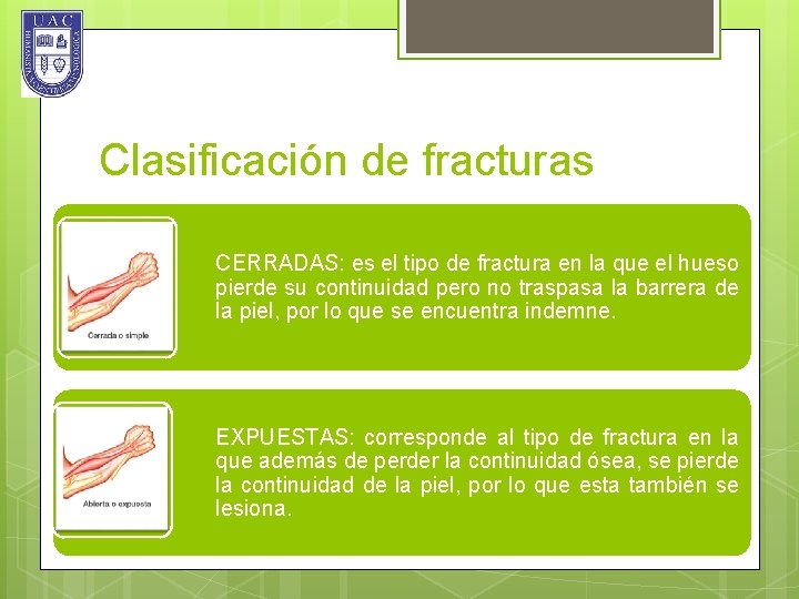 Clasificación de fracturas CERRADAS: es el tipo de fractura en la que el hueso