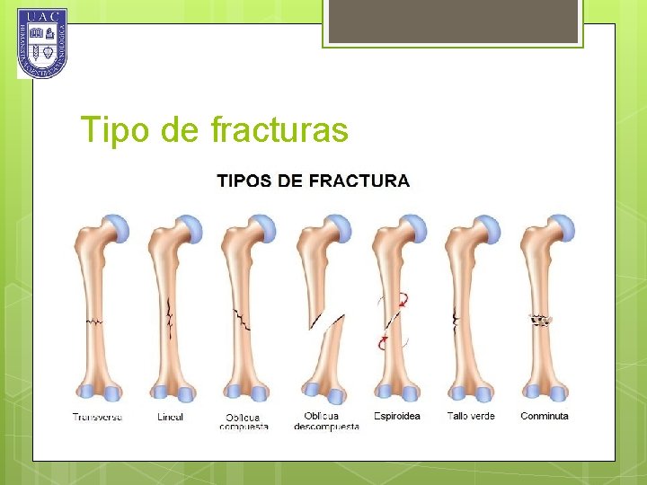 Tipo de fracturas 