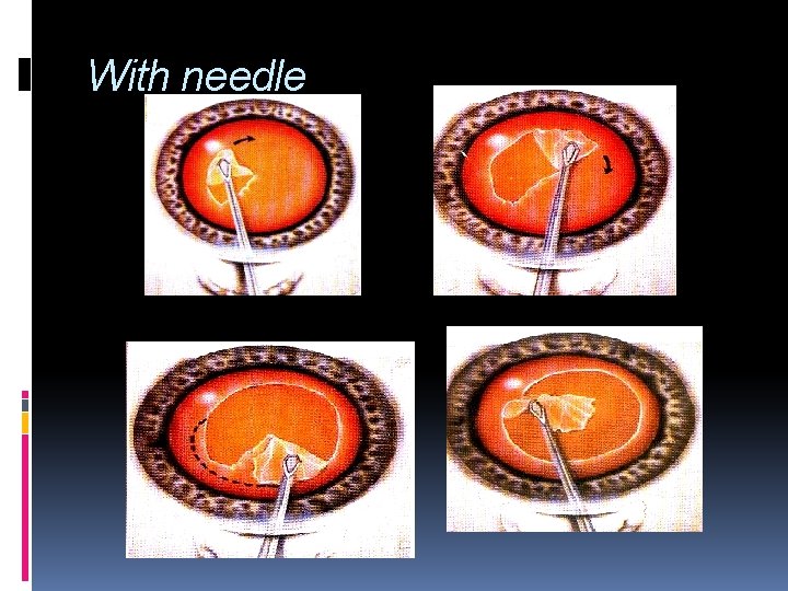 With needle 