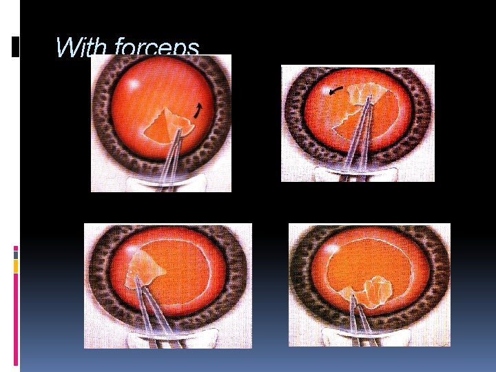 With forceps 