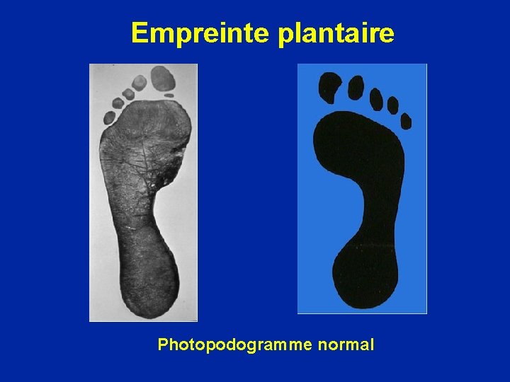 Gnralits Anatomie Rappel Examen Du Pied Pied Plat gnralits-anatomie-rappel-examen-du-pied-pied-plat