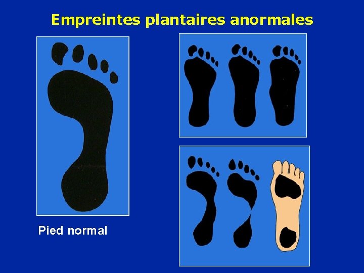 Empreintes plantaires anormales Pied normal 