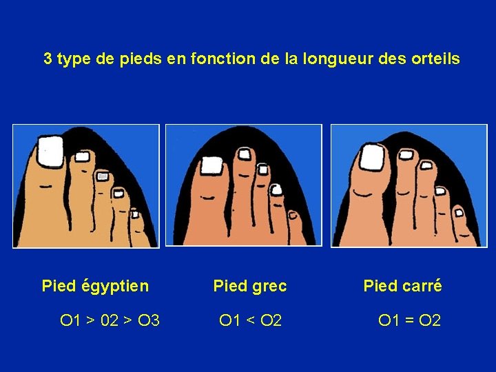 3 type de pieds en fonction de la longueur des orteils Pied égyptien Pied
