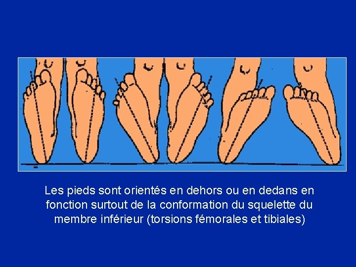 Les pieds sont orientés en dehors ou en dedans en fonction surtout de la
