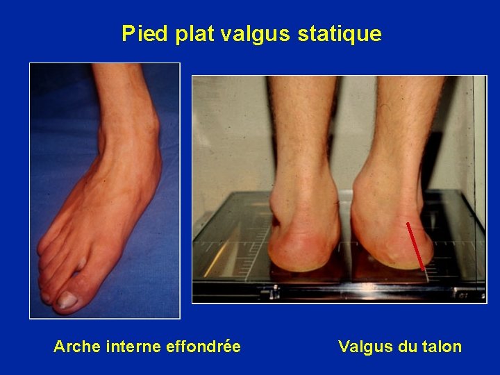 Pied plat valgus statique Arche interne effondrée Valgus du talon 