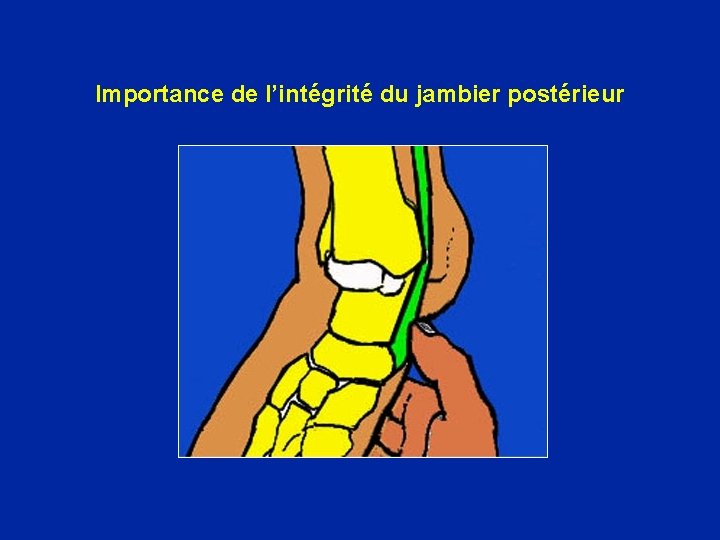Importance de l’intégrité du jambier postérieur 