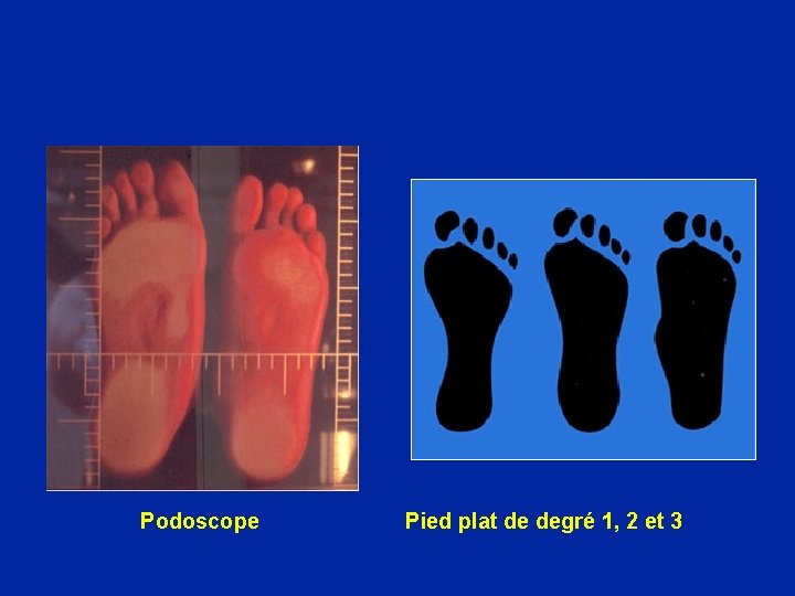 Podoscope Pied plat de degré 1, 2 et 3 