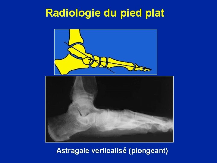 Radiologie du pied plat Astragale verticalisé (plongeant) 