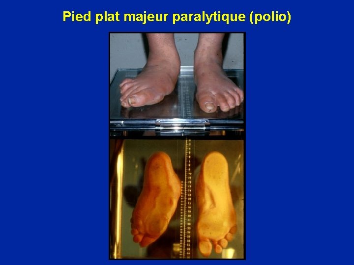 Pied plat majeur paralytique (polio) 