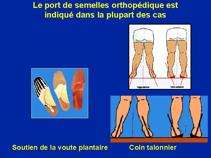 Le port de semelles orthopédique est indiqué dans la plupart des cas Soutien de