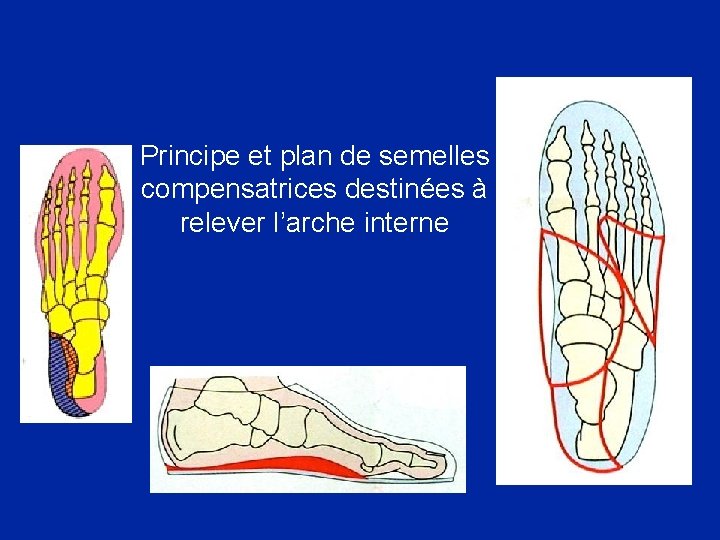 Principe et plan de semelles compensatrices destinées à relever l’arche interne 