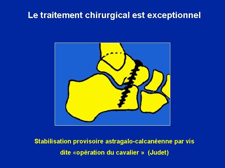 Le traitement chirurgical est exceptionnel Stabilisation provisoire astragalo-calcanéenne par vis dite «opération du cavalier