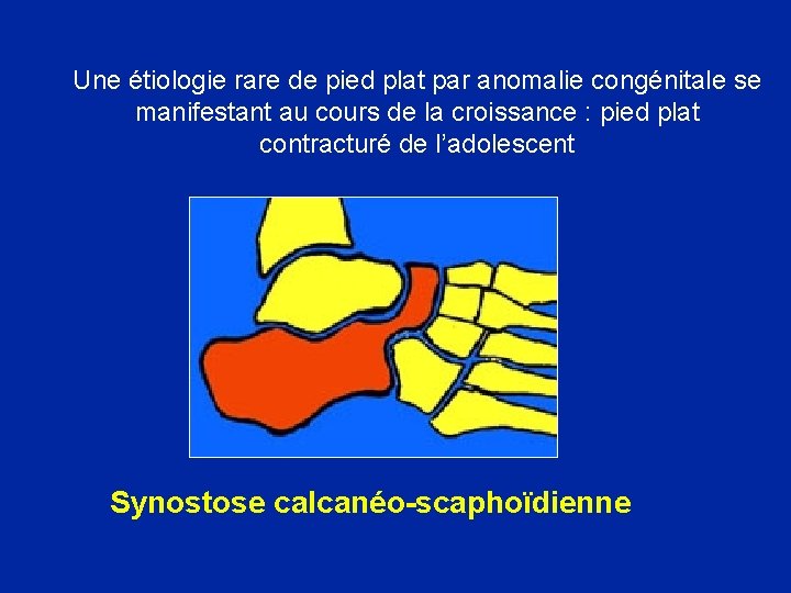Une étiologie rare de pied plat par anomalie congénitale se manifestant au cours de