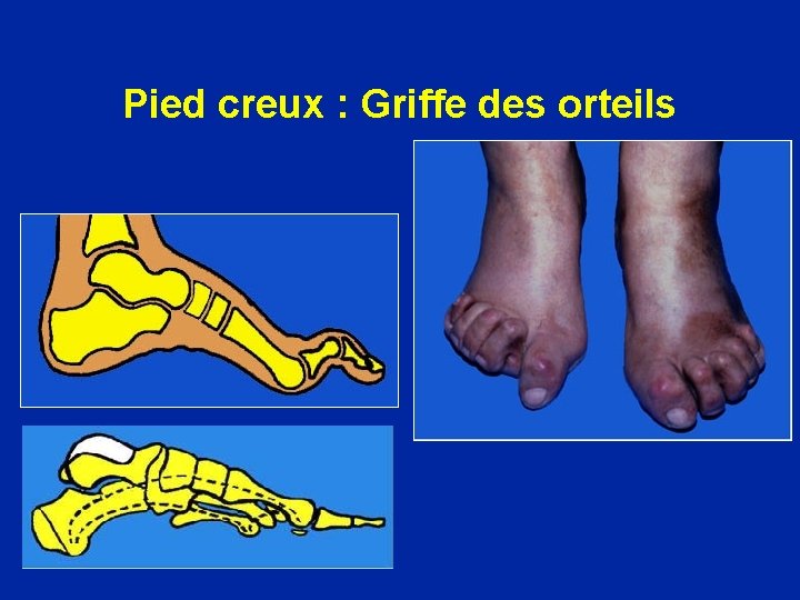 Pied creux : Griffe des orteils 