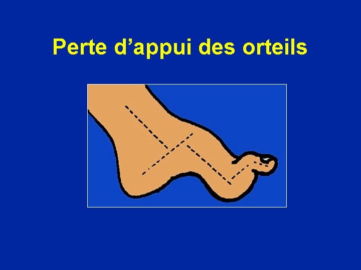 Perte d’appui des orteils 