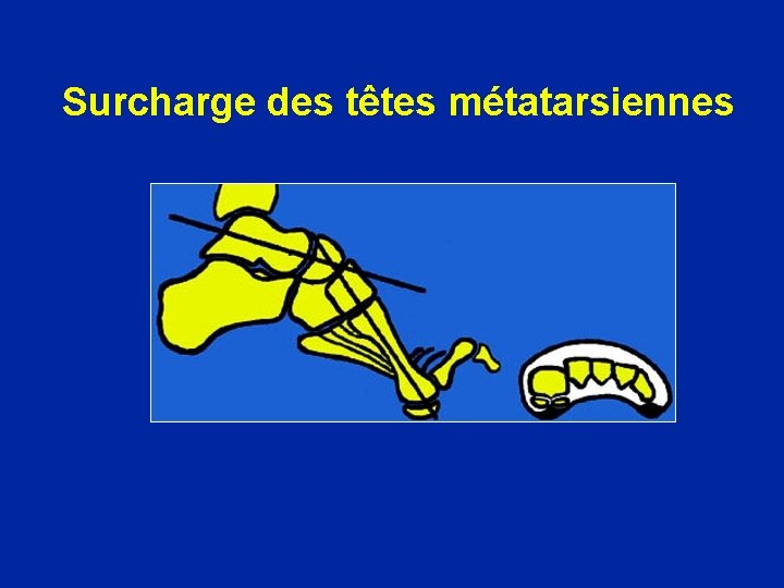 Surcharge des têtes métatarsiennes 