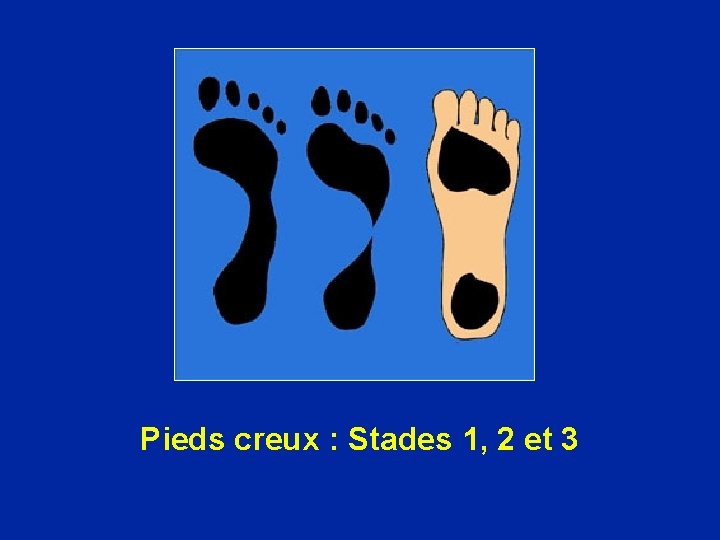 Pieds creux : Stades 1, 2 et 3 