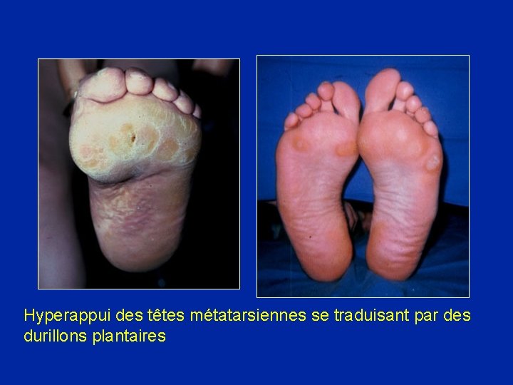 Hyperappui des têtes métatarsiennes se traduisant par des durillons plantaires 