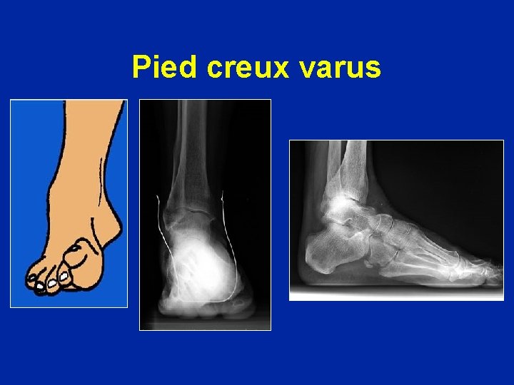 Pied creux varus 
