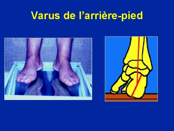 Varus de l’arrière-pied 