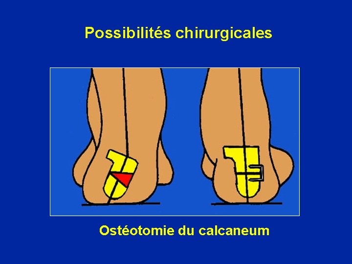 Possibilités chirurgicales Ostéotomie du calcaneum 