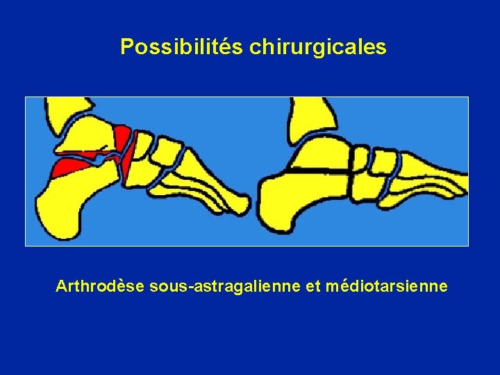 Possibilités chirurgicales Arthrodèse sous-astragalienne et médiotarsienne 