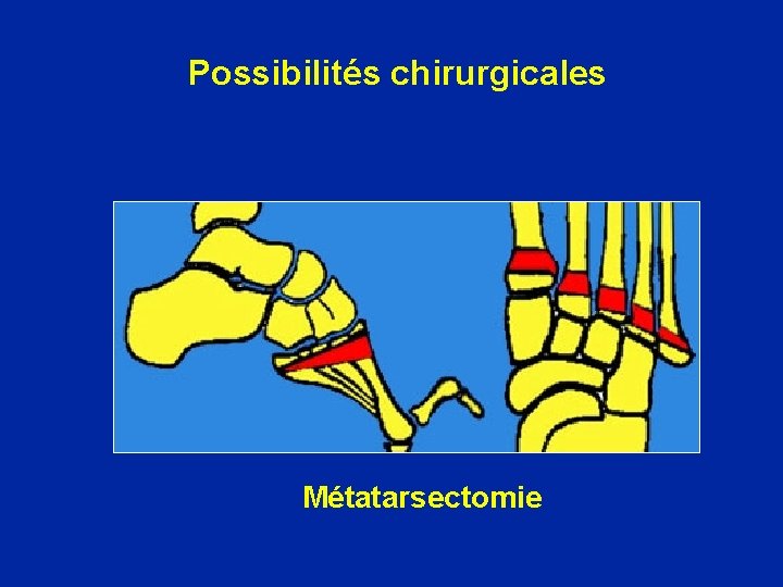 Possibilités chirurgicales Métatarsectomie 