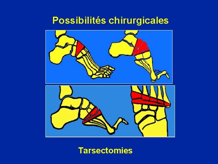 Possibilités chirurgicales Tarsectomies 
