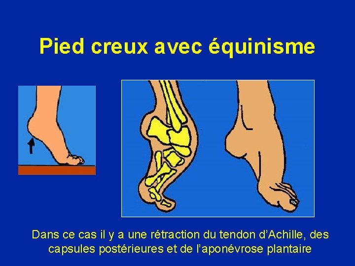 Pied creux avec équinisme Dans ce cas il y a une rétraction du tendon