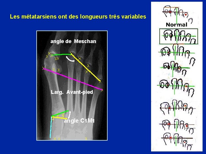 Les métatarsiens ont des longueurs très variables angle de Meschan Larg. Avant-pied angle C