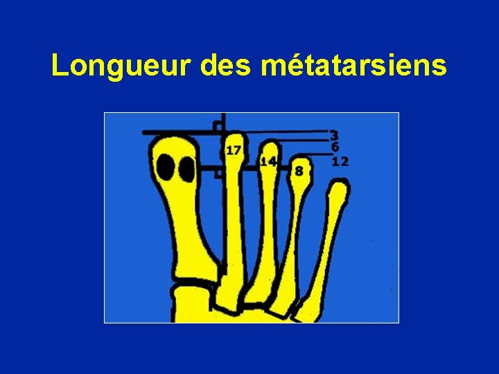 Longueur des métatarsiens 