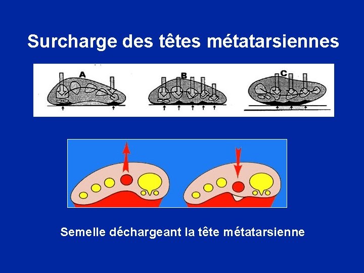 Surcharge des têtes métatarsiennes Semelle déchargeant la tête métatarsienne 